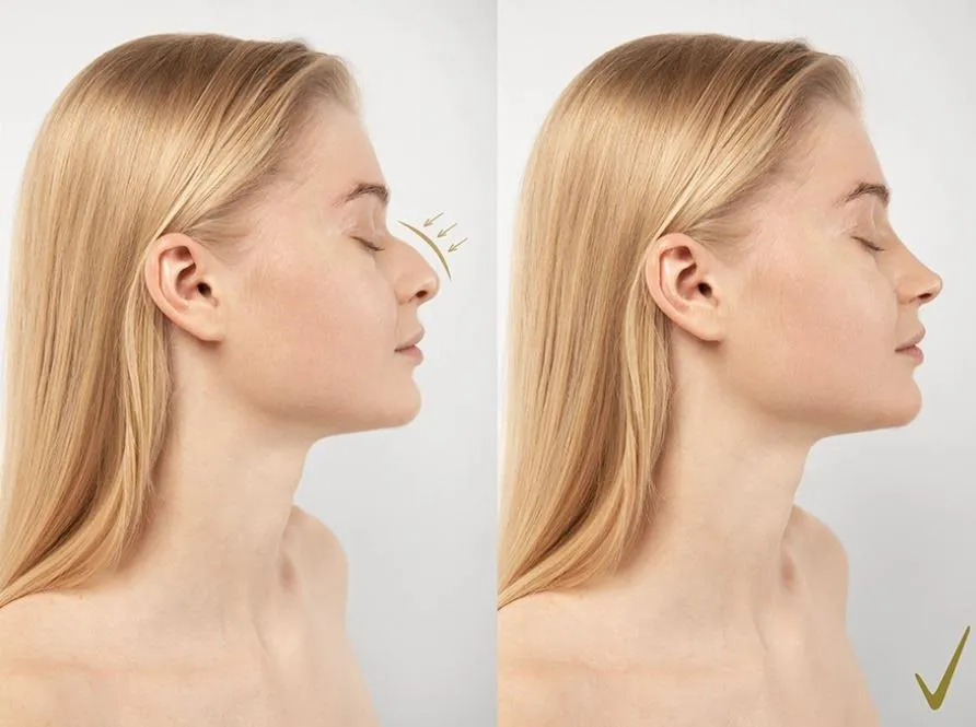 2025 Burun Estetiği Fiyatları Hakkında Detaylı Kılavuz